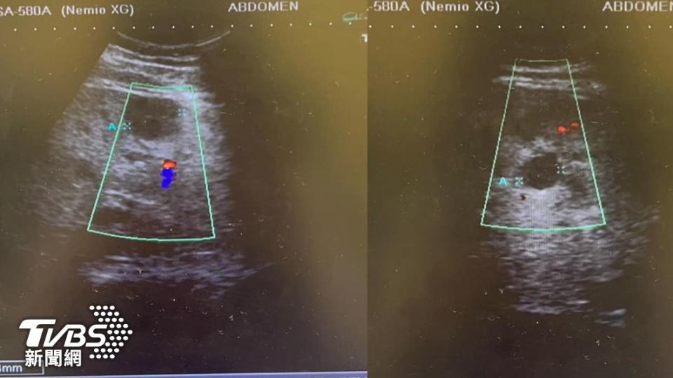 患者肝臟有多顆低迴音的結節。（圖／唐子涵授權提供）