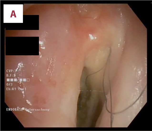 Typically, there were six to nine 2-inch hairs in the man’s throat, with some passing through his larynx and growing into his mouth. American Journal of Case Reports