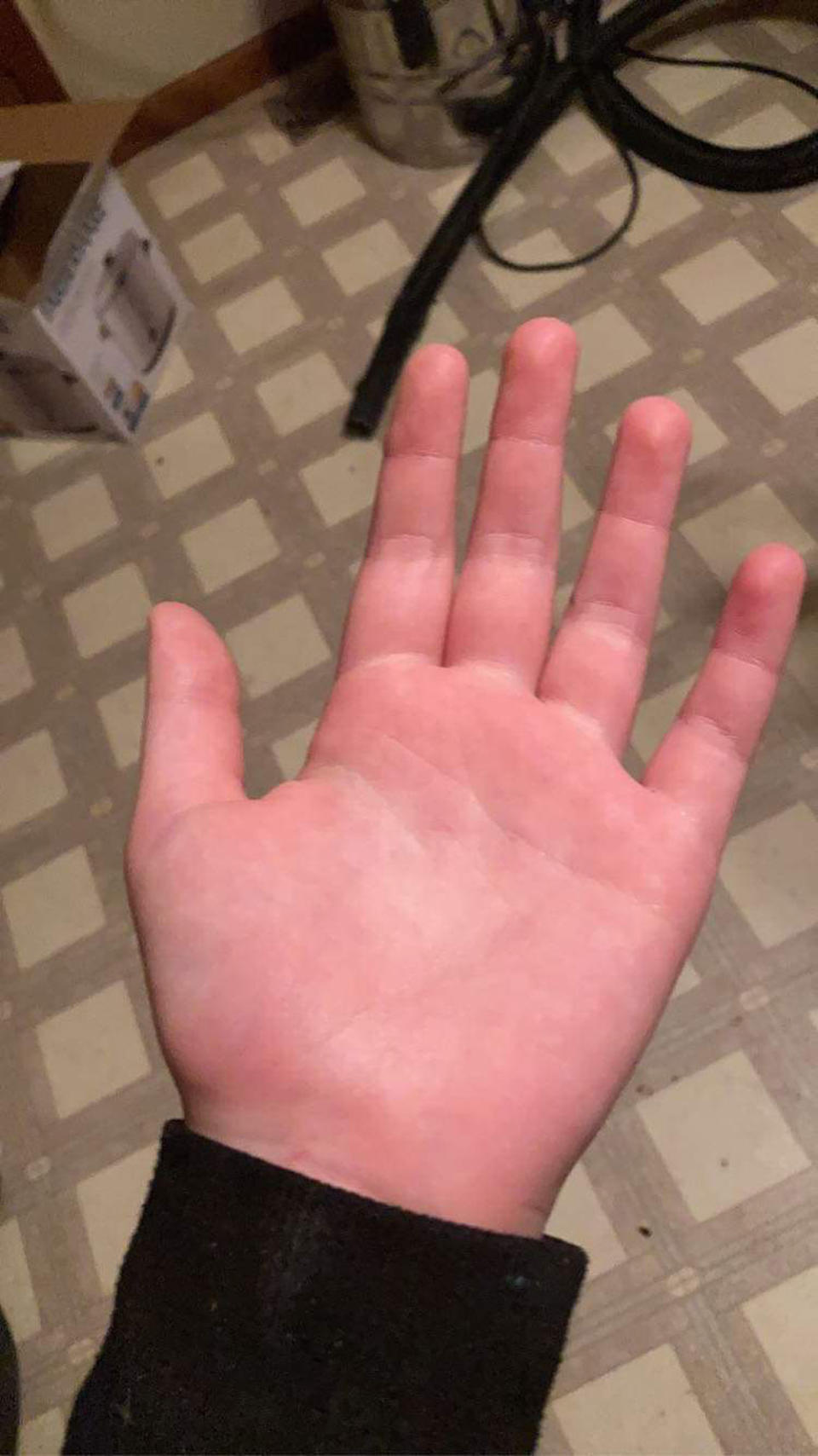 What her hand looks like after a shower (Collect/PA Real Life)