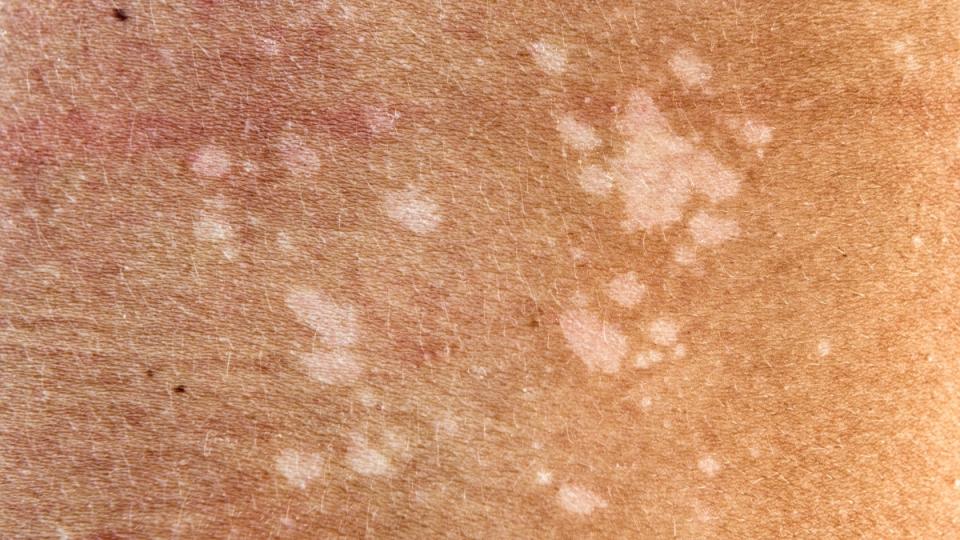 Tinea versicolor, which causes discolored white patches on skin