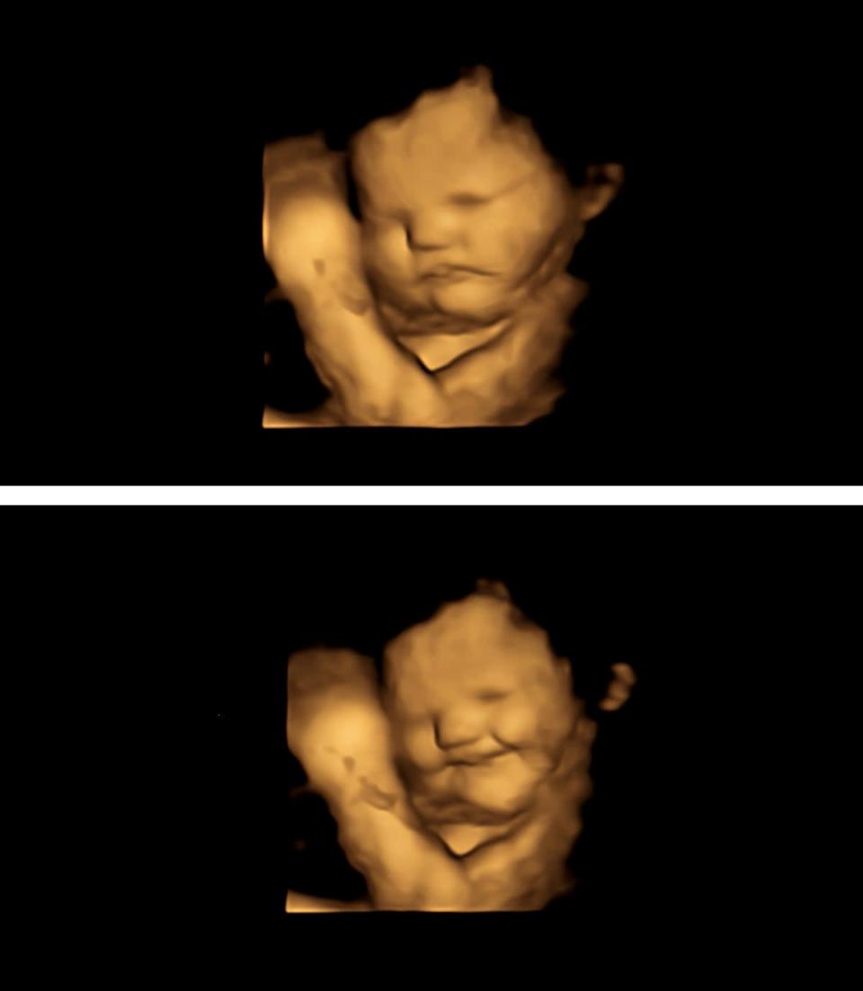 Imagen del folleto de un escaneo 4D de un feto que muestra una cara neutra (arriba) y el mismo feto que muestra una reacción de cara de risa después de haber estado expuesto al sabor a zanahoria (Universidad de Durham/PA) (PA Media)