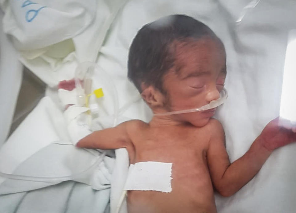 In this photo provided anonymously, a newborn baby weighing just 800 grams (1.7 lbs) is treated in a clinic before dying shortly after he was born along with his malnourished mother on Tuesday, Sept. 14, 2021, in the Tigray region of northern Ethiopia. For months, the United Nations has warned of famine in Tigray and now internal documents and witness accounts reveal the first starvation deaths since Ethiopia's government in June imposed what the U.N. calls "a de facto humanitarian aid blockade." (UGC via AP)