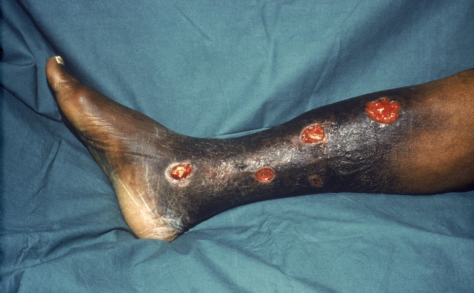 Yaws is a chronic,&nbsp;<a href="http://www.who.int/mediacentre/factsheets/fs316/en/">disfiguring childhood infectious disease</a>.&nbsp;Affecting skin, bone and cartilage, the symptoms show up weeks to months after infection and include yellow lesions and bone swelling. More than 250,000 cases of yaws were reported from 2010 to 2013, WHO told HuffPost.&nbsp;A&nbsp;lack of clean water and soap for bathing contributes to its spread. Only 13 countries are known to still have cases of yaws, including <a href="https://www.ncbi.nlm.nih.gov/pubmed/26001576" target="_blank">Ghana, Papua New Guinea and Solomon Islands</a>.