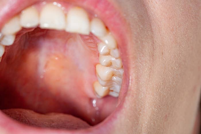 Close-up of a person's open mouth showing teeth and the upper palate