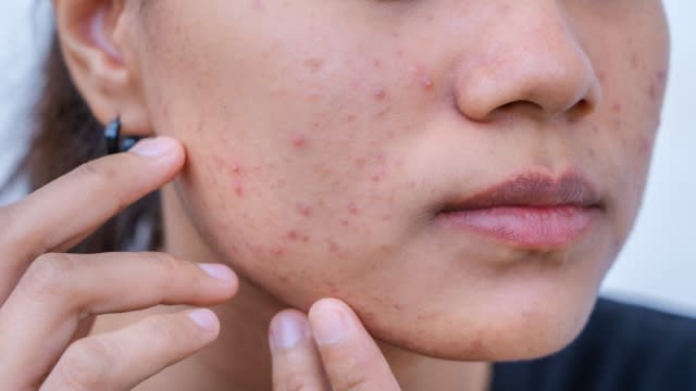 A person with acne is shown