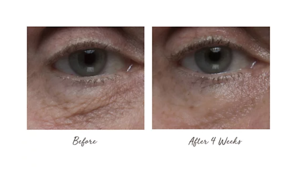 One user's impressive then-and-now experience with PerriconeMD Eyelid Lift Serum. (Photo: QVC)