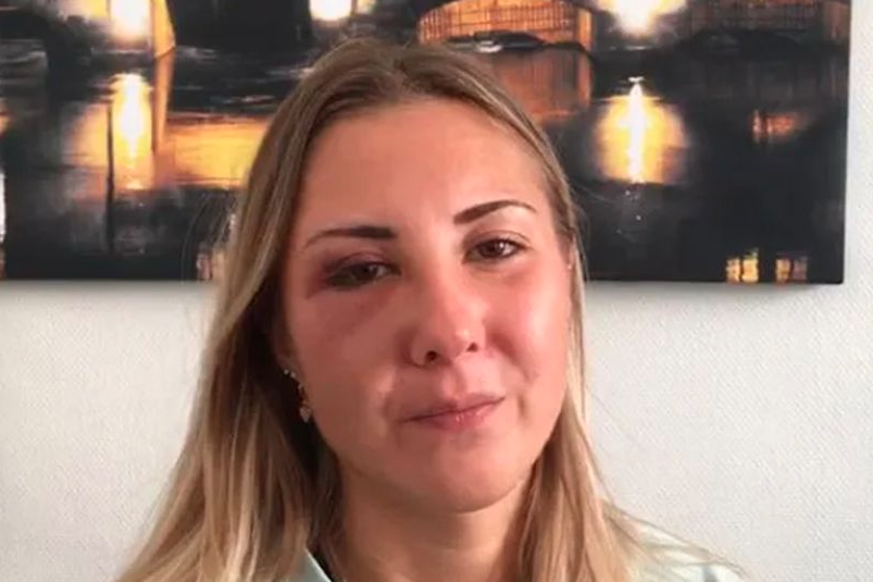 Pictured is Elisabeth with a bruised eye after she was attacked for wearing a skirt. 