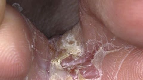 athlete's foot skin rash