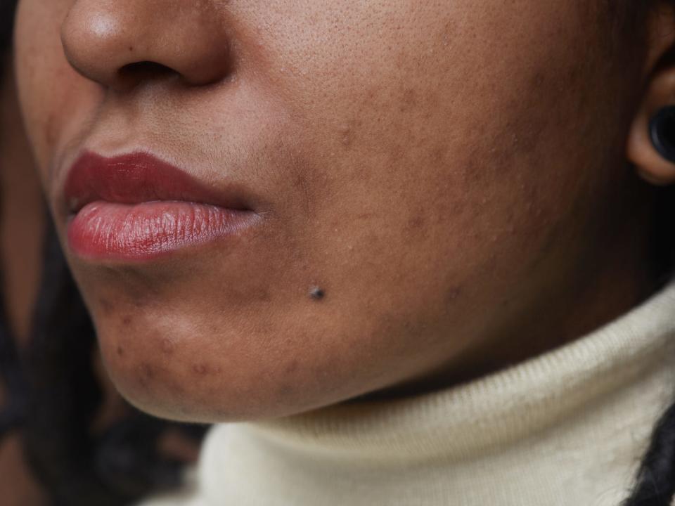 A Black woman with acne on her chin.