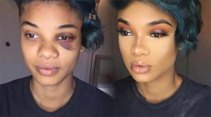 A model who goes by the name Troi posted a “before” photo with a bruise she sustained from her brother, who has a mental illness, and an “after” photo post-makeover. (Photo: Instagram/thereal_troi)