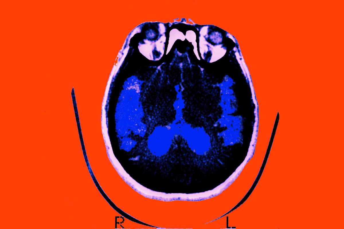 alzheimer-s-drug-slowed-progression-of-the-disease-in-phase-3-trial