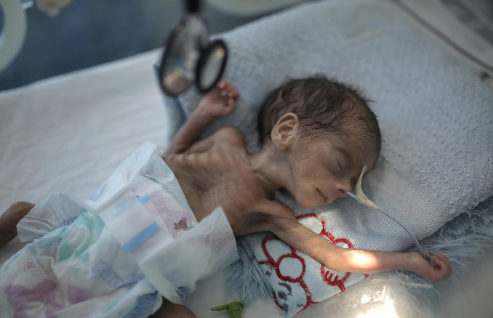 FILE - In this Nov. 23, 2019 file photo, a malnourished newborn baby lies in an incubator at Al-Sabeen hospital in Sanaa, Yemen. The United Nations Children’s Fund on Monday, Dec. 7, 2020, launched a global appeal for a record $2.5 billion of emergency assistance for the Middle East and North Africa, saying the funds were necessary to respond to the needs of millions of children across a region hit hard by conflict, natural disaster and the coronavirus crisis. (AP Photo/Hani Mohammed, File)