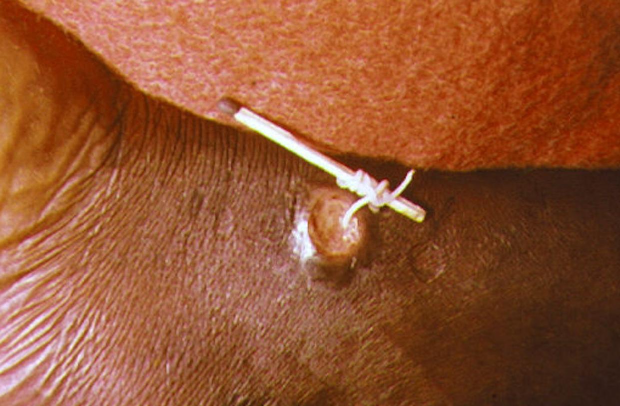 Guinea worms are long, white parasites that emerge from the legs of infected people through painful blisters. <a href="https://commons.wikimedia.org/wiki/File:Dracunculus_medinensis.jpg#/media/File:Dracunculus_medinensis.jpg" rel="nofollow noopener" target="_blank" data-ylk="slk:CDC/Wikimedia Commons;elm:context_link;itc:0;sec:content-canvas" class="link ">CDC/Wikimedia Commons</a>