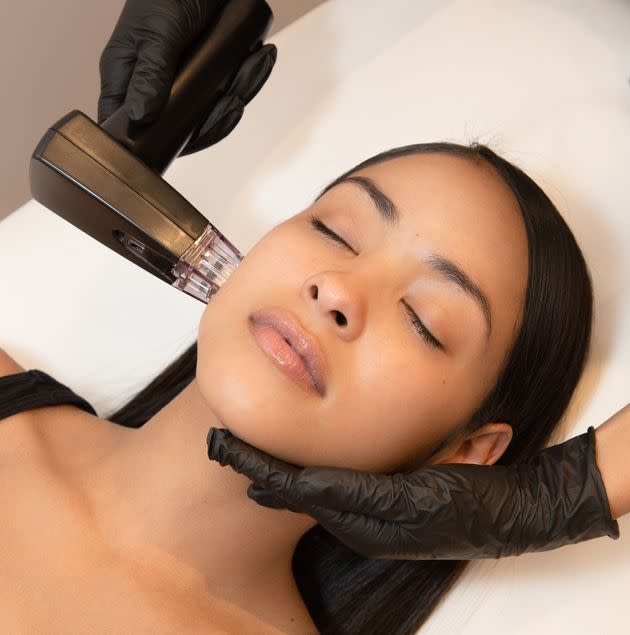 A patient undergoes remodeling, which combines microneedling and radiofrequency technology to tighten loose skin. (Photo: Luxbae Medical Spa)