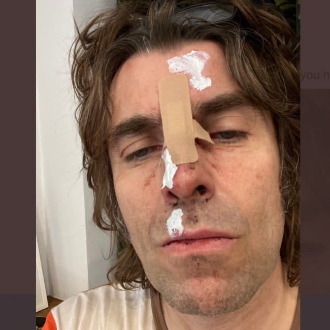 Imagen compartida por Liam Gallagher tras su accidente credit:Bang Showbiz