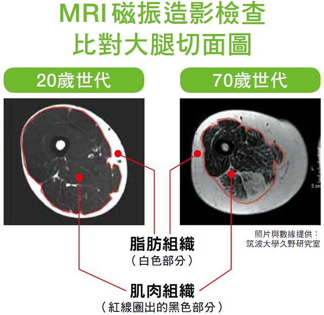 MRI磁振造影檢查比對大腿切面圖