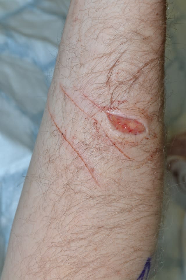 A wound on Pc Outten's arm
