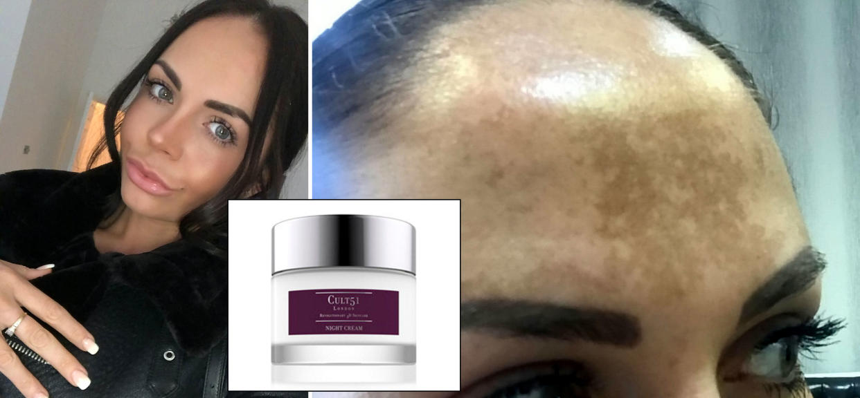 A woman who spent £4000 on treatments for sun damage has found a miracle cure via an over-the-counter cream [Photo: SWNS]