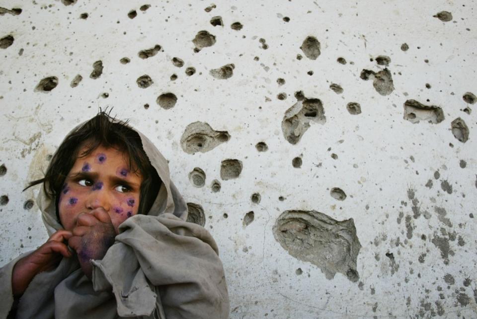 2002年3月1日，阿富汗首都喀布爾，皮膚被細菌感染的7歲女童Mohboba站在滿佈彈孔的牆壁前。