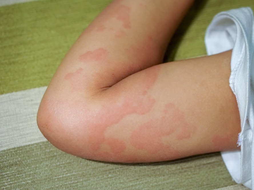 what-causes-me-to-breakout-into-hives-arlington-dermatology