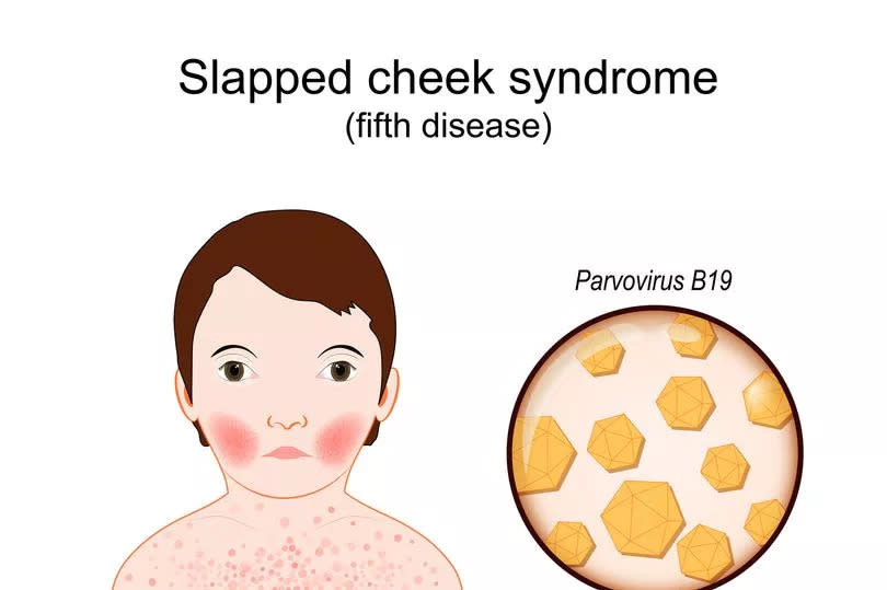 Child with slapped cheek syndrome