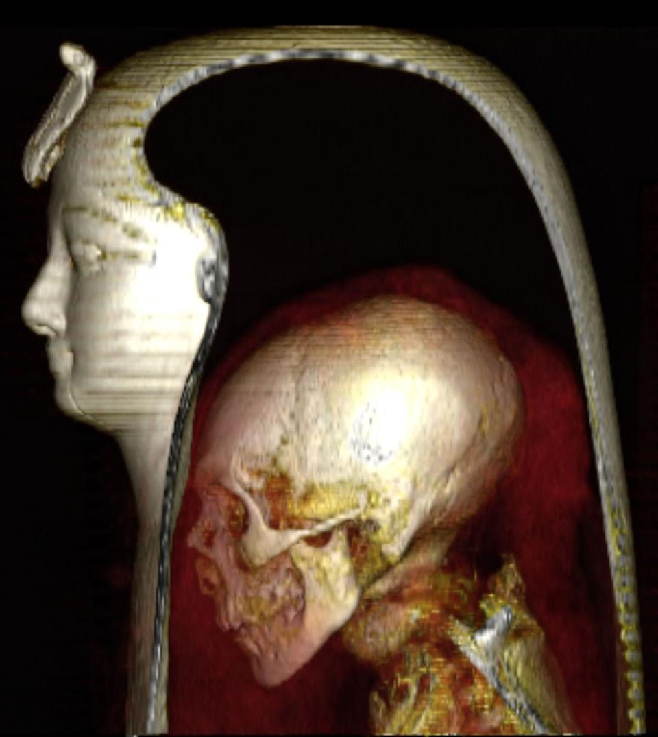 A picture shows a cross section of Amenhotep's mummy inside his face inset