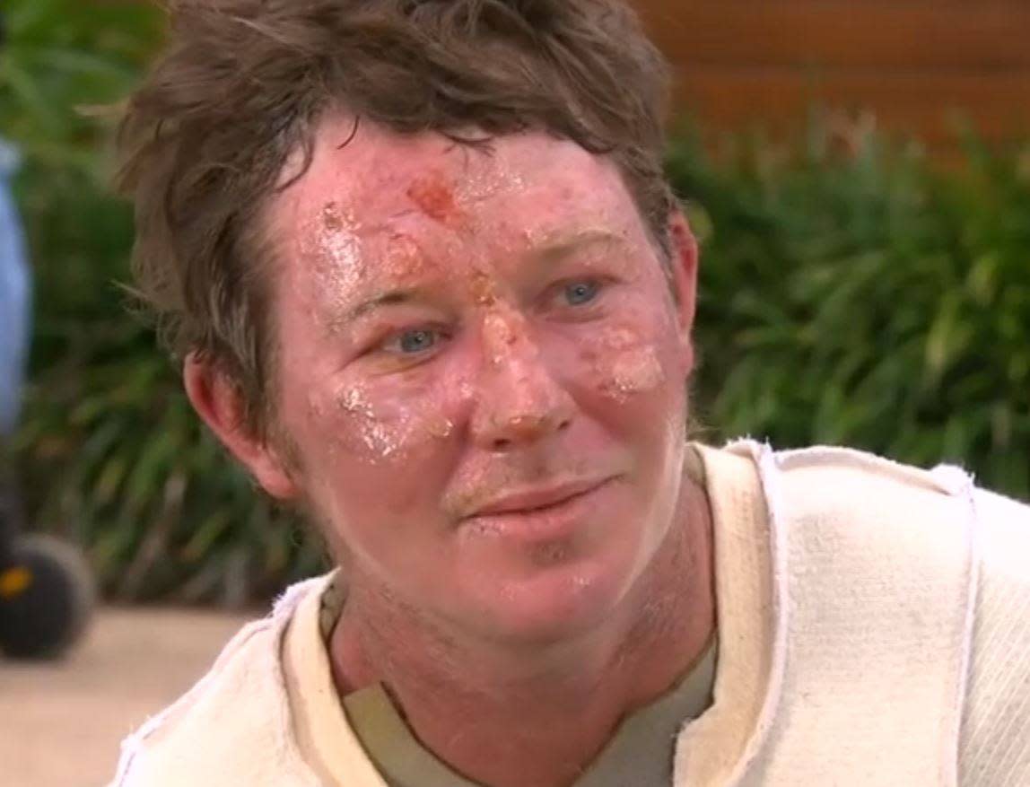 Nathan Perry suffered burns to his face, arms and legs during the fire: Nine News