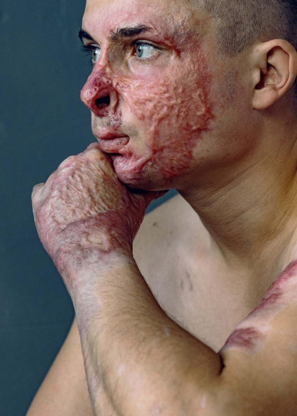 A photo portrait by artist Marta Syrko of Ukrainian soldier Ilya, who was badly burned. Ilya is seen topless in a three-quarter view, chin in hand, looking ahead. Skin on his hand and arm, and much of his face, is badly damaged with red-colored burns on his otherwise white skin.