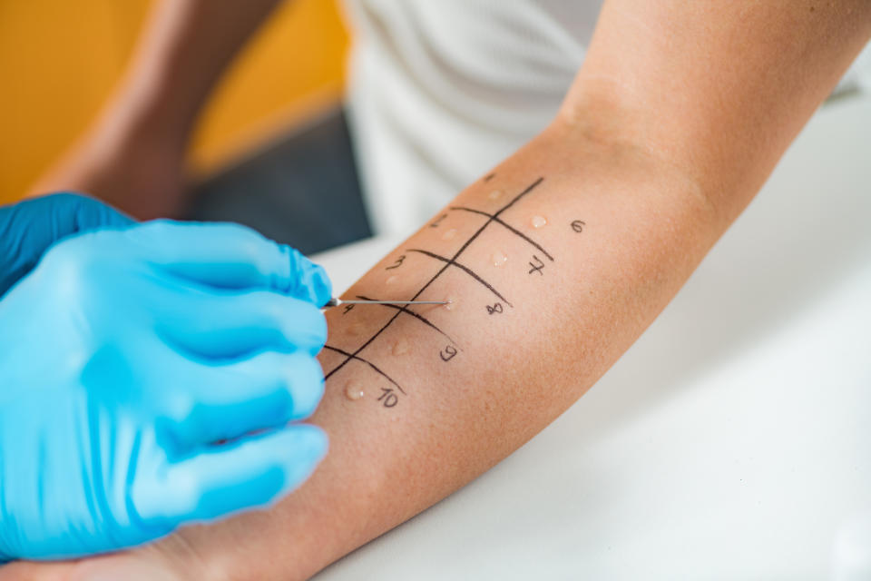 Vorsichtig werden beim Prick-Test, einem der bekanntesten und gängigsten Allergietests, die verschiedenen Stoffe auf die Haut aufgebracht. (Bild: Getty Images)