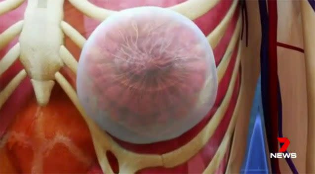 Affecting up to 1 in 1000 women who have had implants, the disease is caused by infection in tissue around the implant. Picture: 7 News