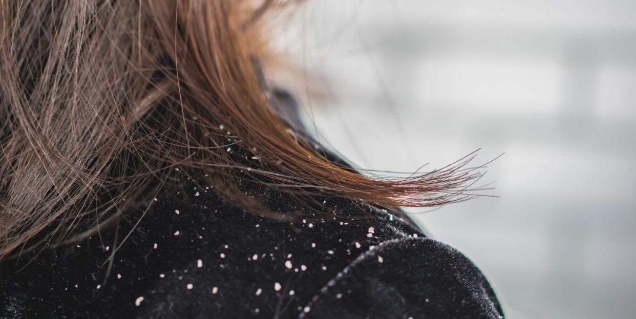 woman hair with dandruff falling on shoulders