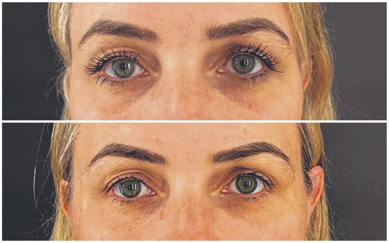 Anna's eyes before (above) and after the procedure