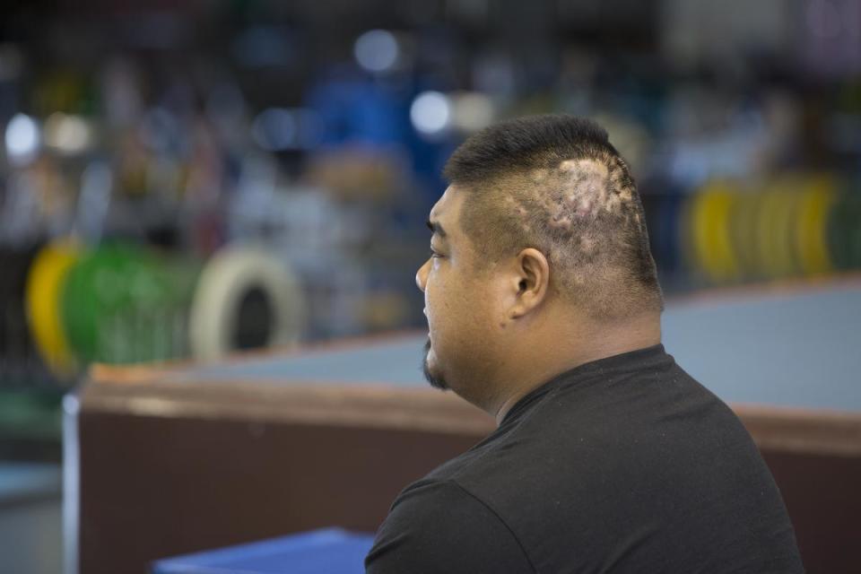 因為比賽的壓力和增胖的關係，陳士杰內分泌失調，後腦出現俗稱「鬼剔頭」的落髮現象。