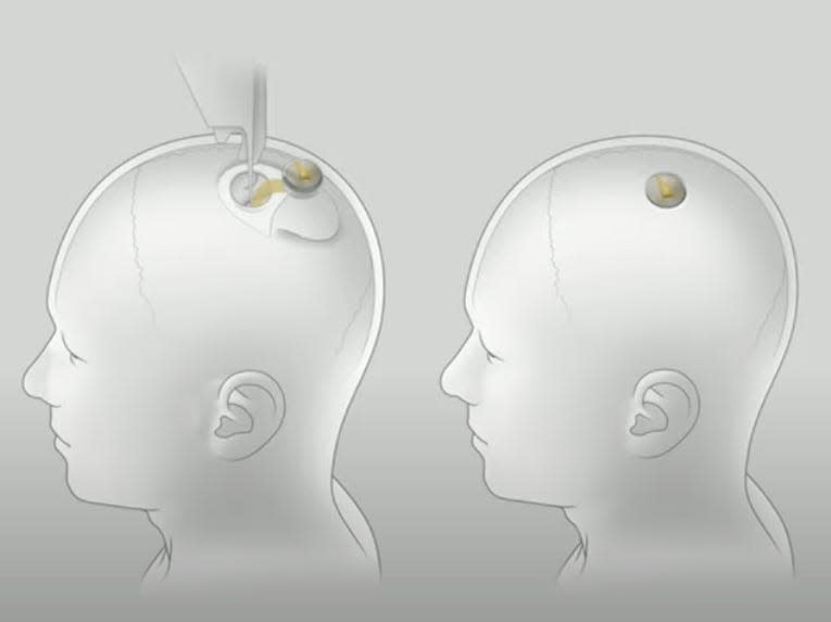 Neuralink brain chip