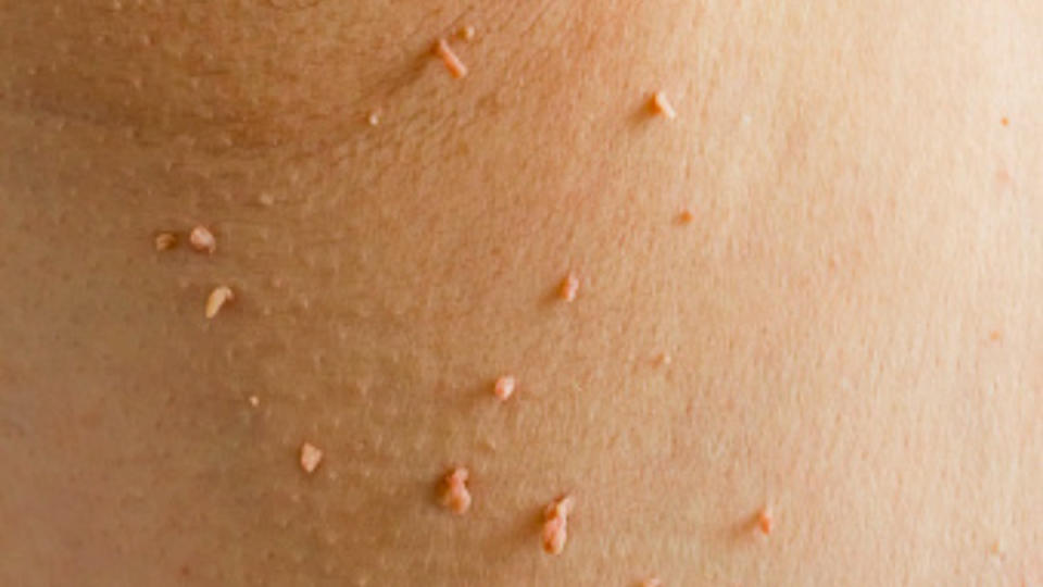 Skin tags growing on an armpit, but the can also grow near the vagina
