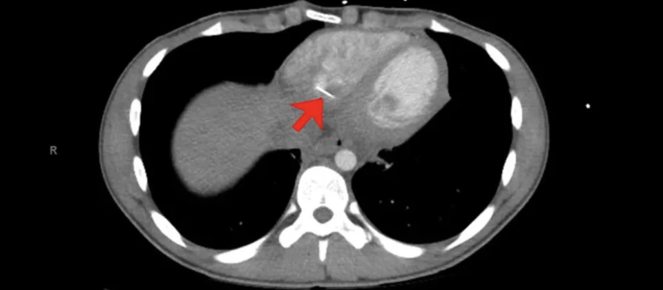 A CT scan of a heart can be seen with a sewing pin lodged inside.