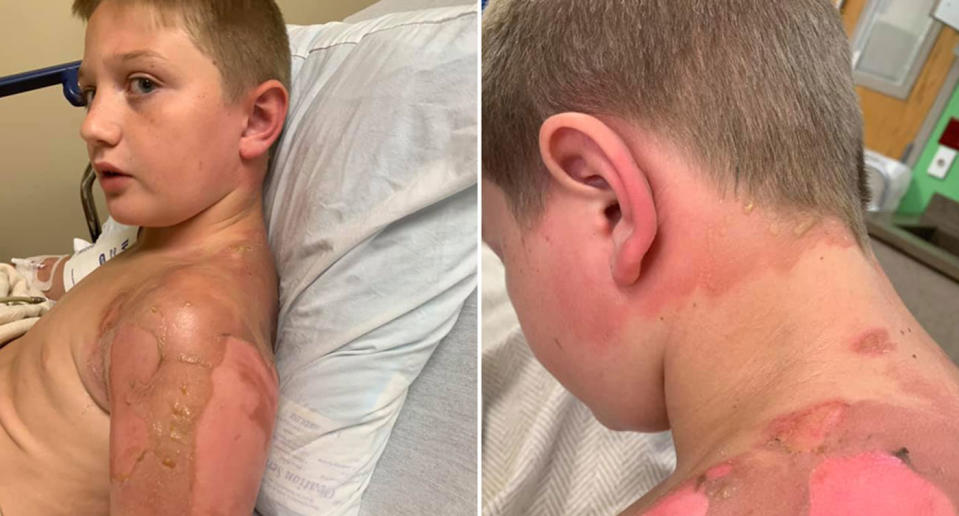 Billy Oliver, 11, with burns on his left shoulder and behind his neck. Billy's mum said he was burned doing the hot water challenge. She claims a friend poured boiling water on him as he slept.