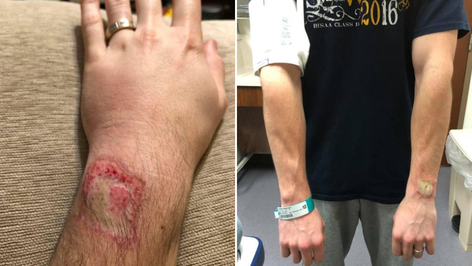 A man posts images of the burn on his wrist after his Fitbit started smoking while he was asleep.