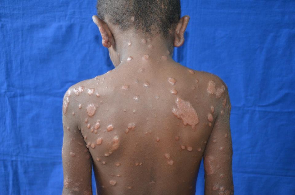 <span class="caption">Severe leprosy case with many lesions in a year old child in Brazil.</span> <span class="attribution"><span class="source">Claudio Salgado</span>, <a class="link " href="http://creativecommons.org/licenses/by-sa/4.0/" rel="nofollow noopener" target="_blank" data-ylk="slk:CC BY-SA;elm:context_link;itc:0;sec:content-canvas">CC BY-SA</a></span>