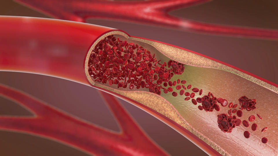 3d illustration of a constricted and narrowed artery (arteriosclerosis).