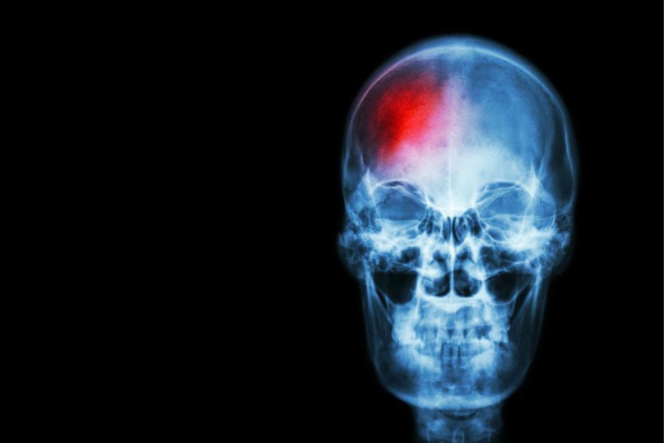 <span class="caption">Vista con Rayos X de una cabeza con un área lateral de la calavera en rojo.</span> <span class="attribution"><a class="link " href="https://www.shutterstock.com/es/image-photo/stroke-cerebrovascular-accident-film-xray-skull-320995667" rel="nofollow noopener" target="_blank" data-ylk="slk:Shutterstock / Puwadol Jaturawutthichai;elm:context_link;itc:0;sec:content-canvas">Shutterstock / Puwadol Jaturawutthichai</a></span>