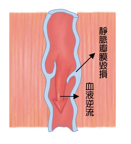 靜脈曲張後，血管被撐開撐大，變得不規則彎曲