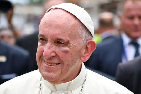 Pope Francis shows a bruise around his left eye and eyebrow caused by an accidental hit against the popemobile's window glass while visiting the old sector of Cartagena, Colombia, on September 10, 2017. REUTERS/Alberto PIZZOLI/Pool