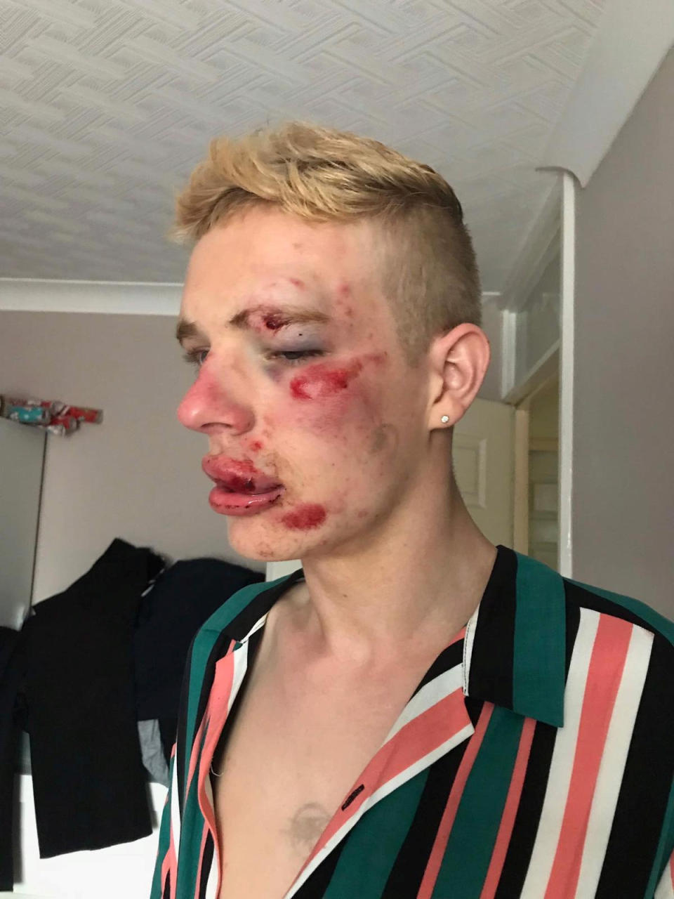 Ryan Williams said he was left Turner injuries from the assault. See SWNS story SWLEpunch. A gay man has spoken out after his attacker who left him unconscious lying on a street after telling him gay is wrong, you all need to die avoided jail. Ryan Williams, 24, spent months drinking and struggling to sleep after he was subjected to a homophobic attack while he was on his way home from work near Manchesters Gay Village. He was with a friend when a group of thugs accosted Ryan and subjected him to a barrage of insults and homophobic slurs before he brutally assaulted him.  Brandon Forrester had been celebrating his 18th birthday on July 13, 2019 when he appraoched Ryan and threatened him, saying gay is wrong and you all need to die.  