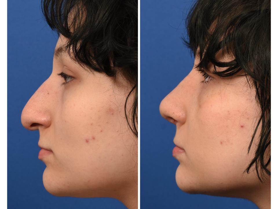 Before and after photos of a 14-year-old's rhinoplasty