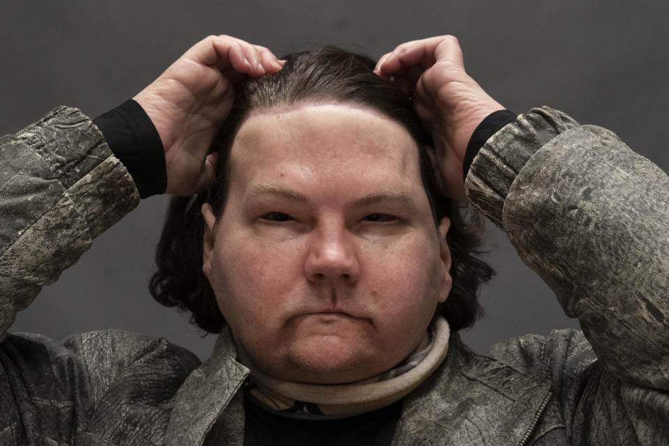 Joe DiMeo brushes back his hair while posing for a portrait, Monday, Jan. 25, 2021 at NYU Langone Health in New York, six months after an extremely rare double hand and face transplant. During a recent medical checkup, he practiced raising his eyebrows, opening and closing his eyes, puckering his mouth, giving a thumbs up and whistling. DiMeo can feel his new forehead, and often reaches up to push his long hair off of his face. (AP Photo/Mark Lennihan)