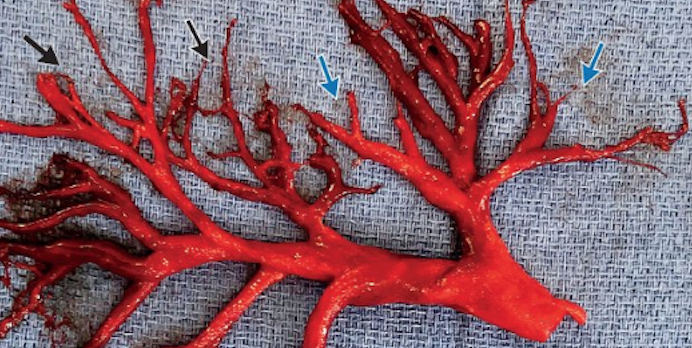 A Big Image Of An Old Dried Red Blood Clot Stock Photo, Picture and Royalty  Free Image. Image 1288955.