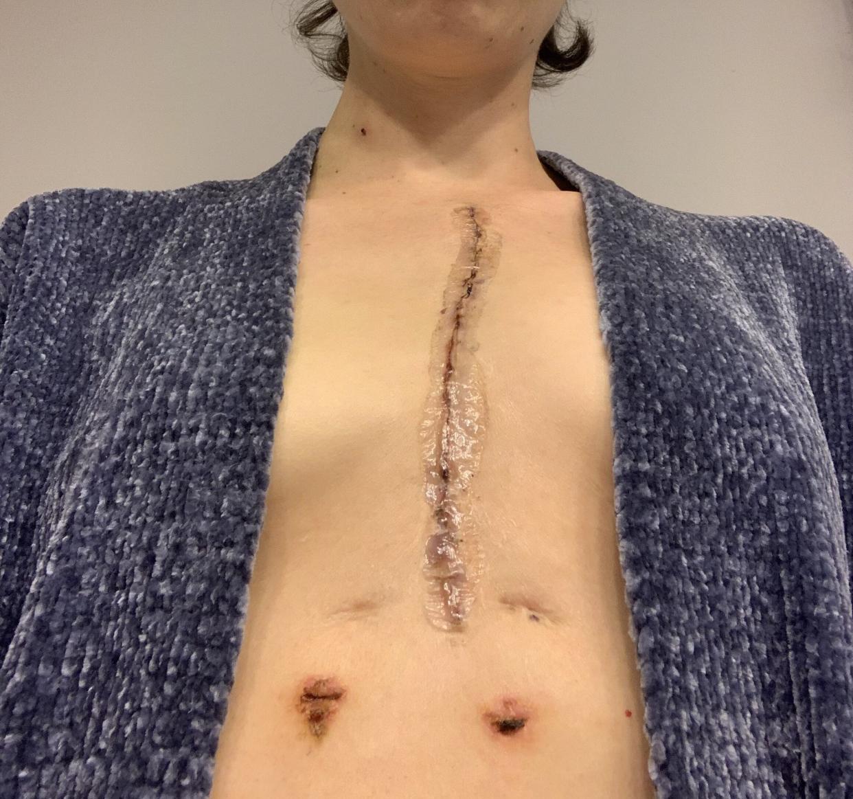 The author's median sternotomy and chest tube scars three weeks post-op. (Photo: Photo Courtesy Of Clare Almand)