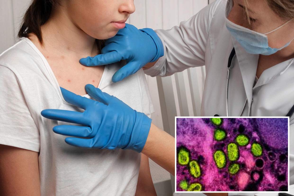 A doctor checks the skin of a girl in the main image. Inset image: a colorized transmission electron micrograph of monkeypox particles (green) found within an infected cell (pink and purple), cultured in the laboratory.