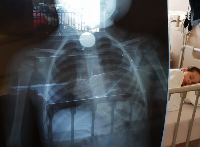 The X-ray showed the 10 cent coin stuck directly in the three-year-old’s oesophagus. Source: Ambulance Victoria